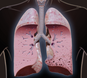 Fibrose pulmonar. Doença intersticial pulmonar.