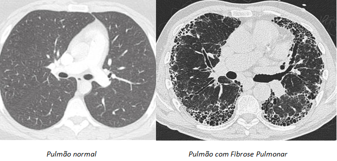 Imagem de tomografia de tórax mostrando pulmão normal e pulmão com fibrose pulmonar.