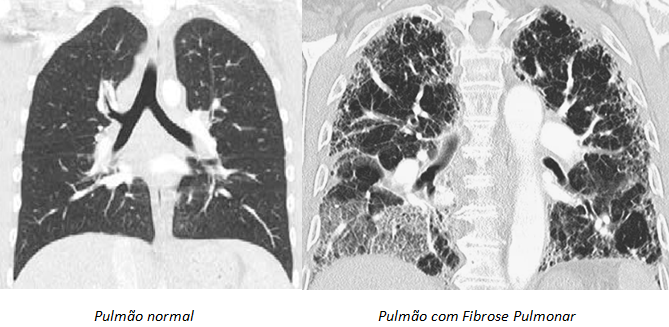 Imagem de tomografia de tórax mostrando pulmão normal e pulmão com fibrose pulmonar.