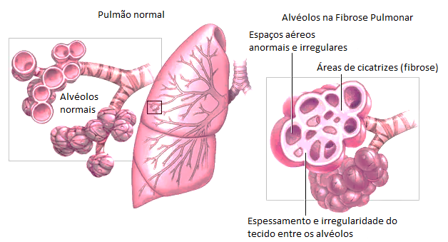Patologia da fibrose pulmonar.