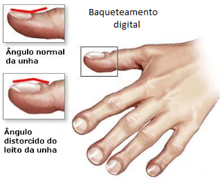 Baqueteamento digital presente em pacientes com fibrose pulmonar.