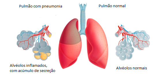 Patologia da pneumonia, evidenciando pulmão normal e pulmão acometido por pneumonia.