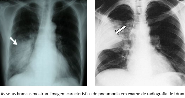 Radiografia de tórax mostrando imagem de pneumonia.