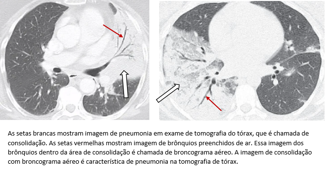 Tomografia de tórax mostrando imagem de pneumonia.