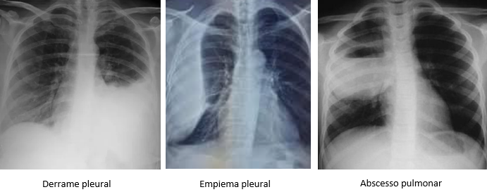 Possíveis complicações da pneumonia.