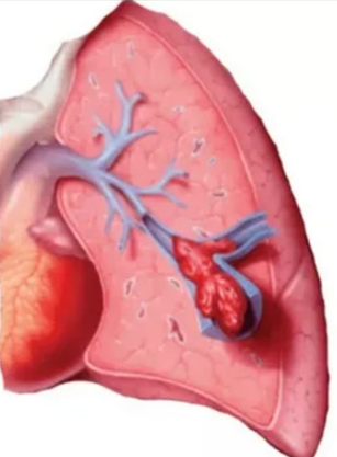 Tromboembolia pulmonar (TEP).