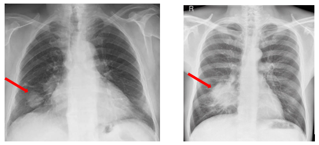 Câncer de pulmão na radiografia de tórax.